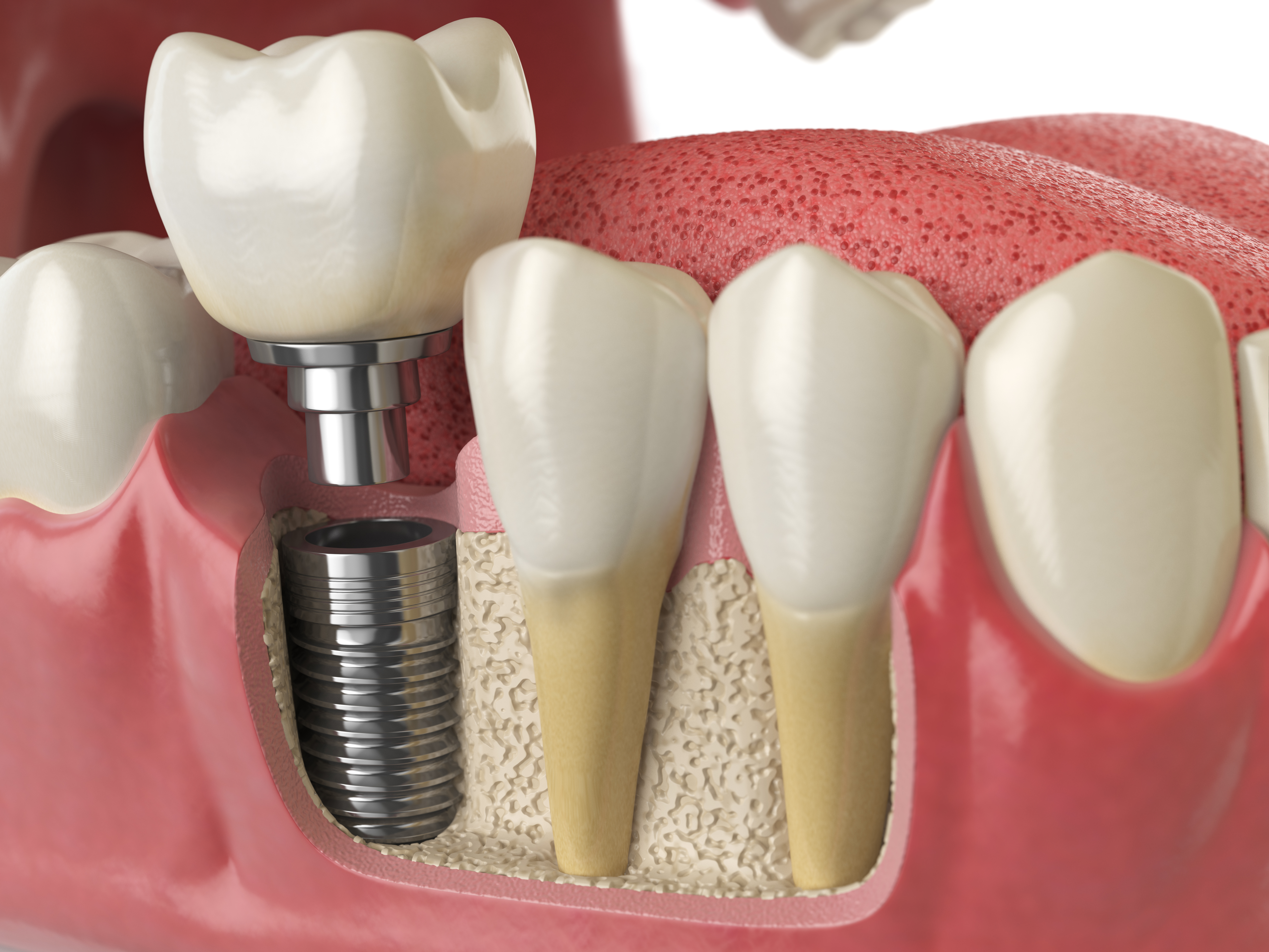 Dental implant care for nervous patients in London