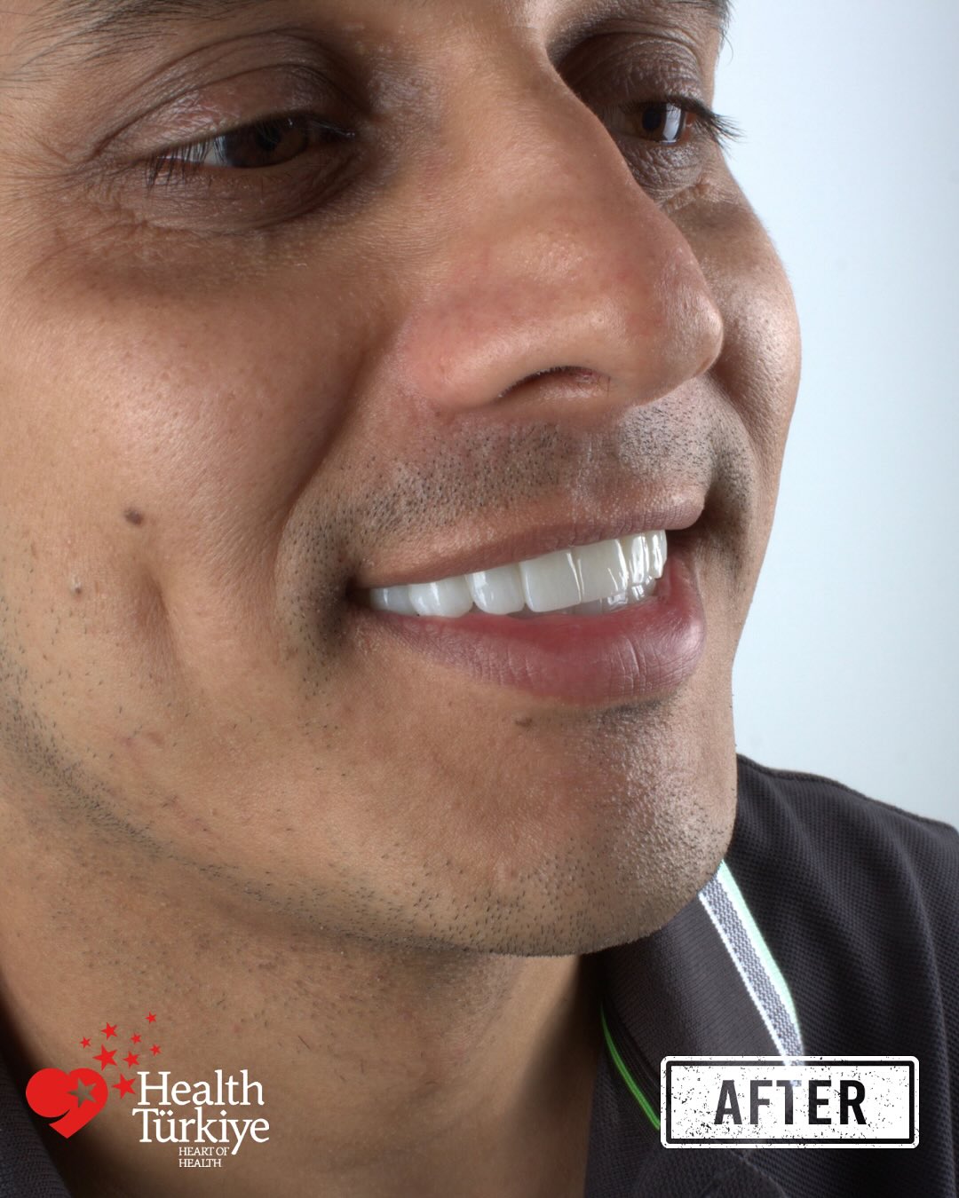 After — Full mouth rehabilitation