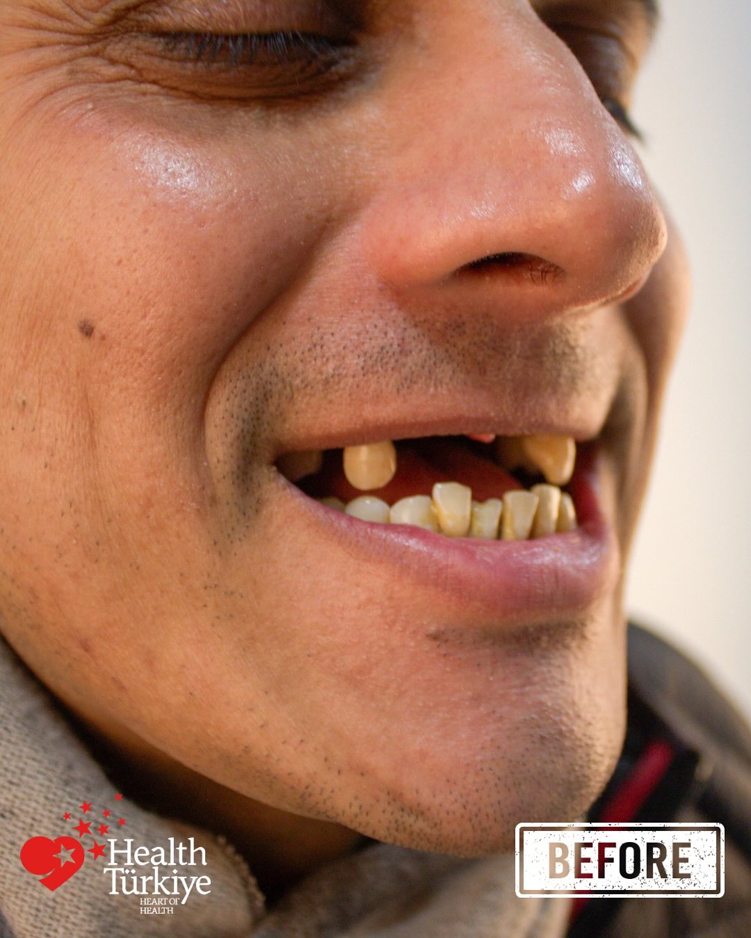 Before — Full mouth rehabilitation