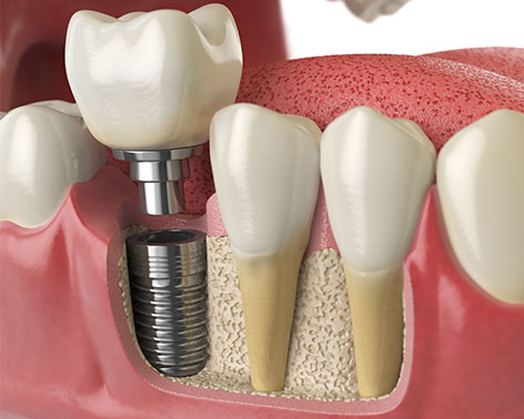 Dental Implants with Bone Loss