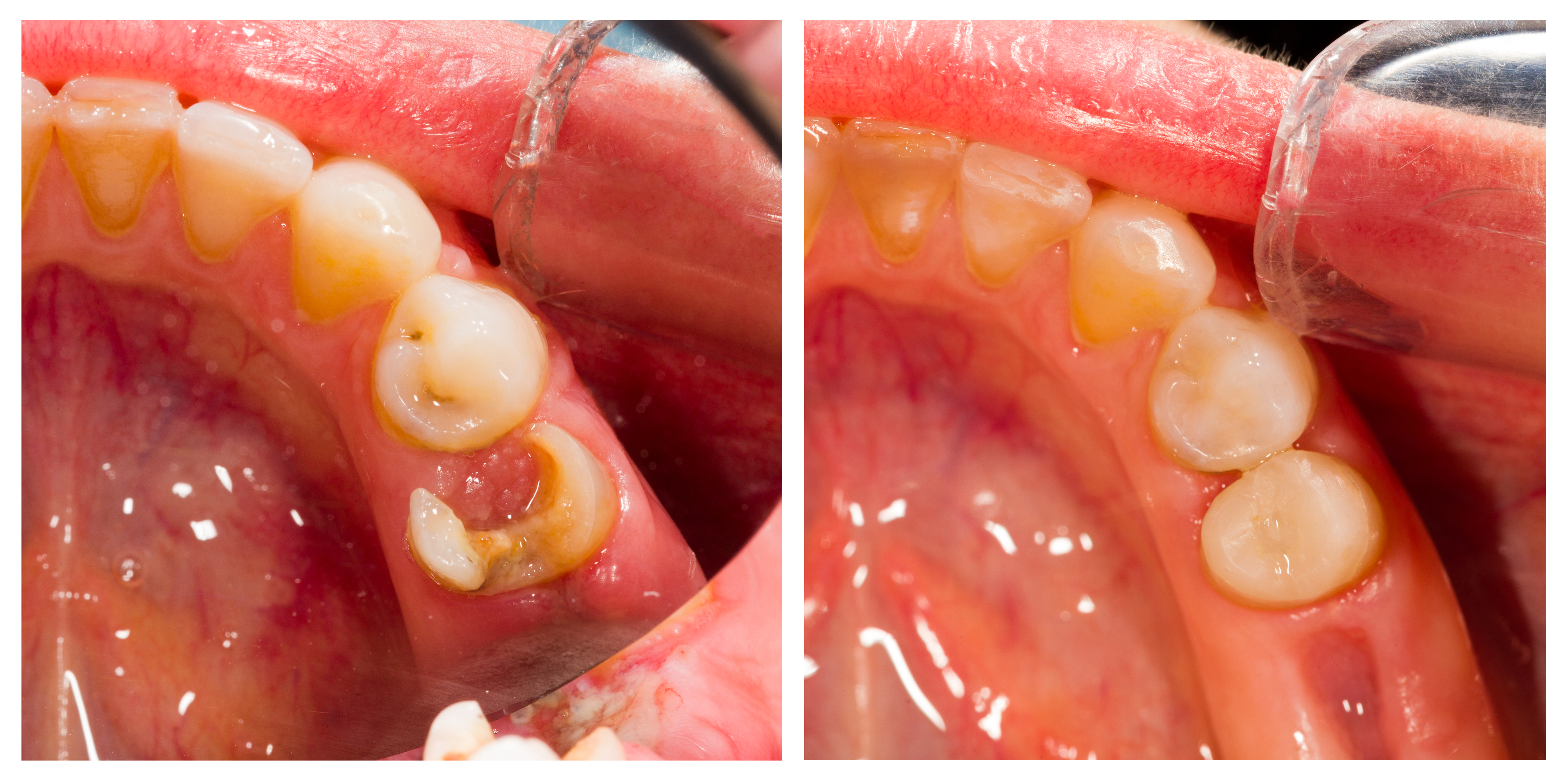 Restorative dentistry consultation at DentAkademi London