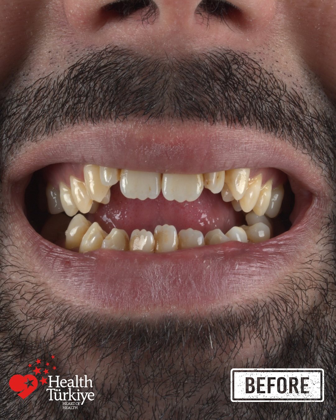 Before — Invisalign crowding