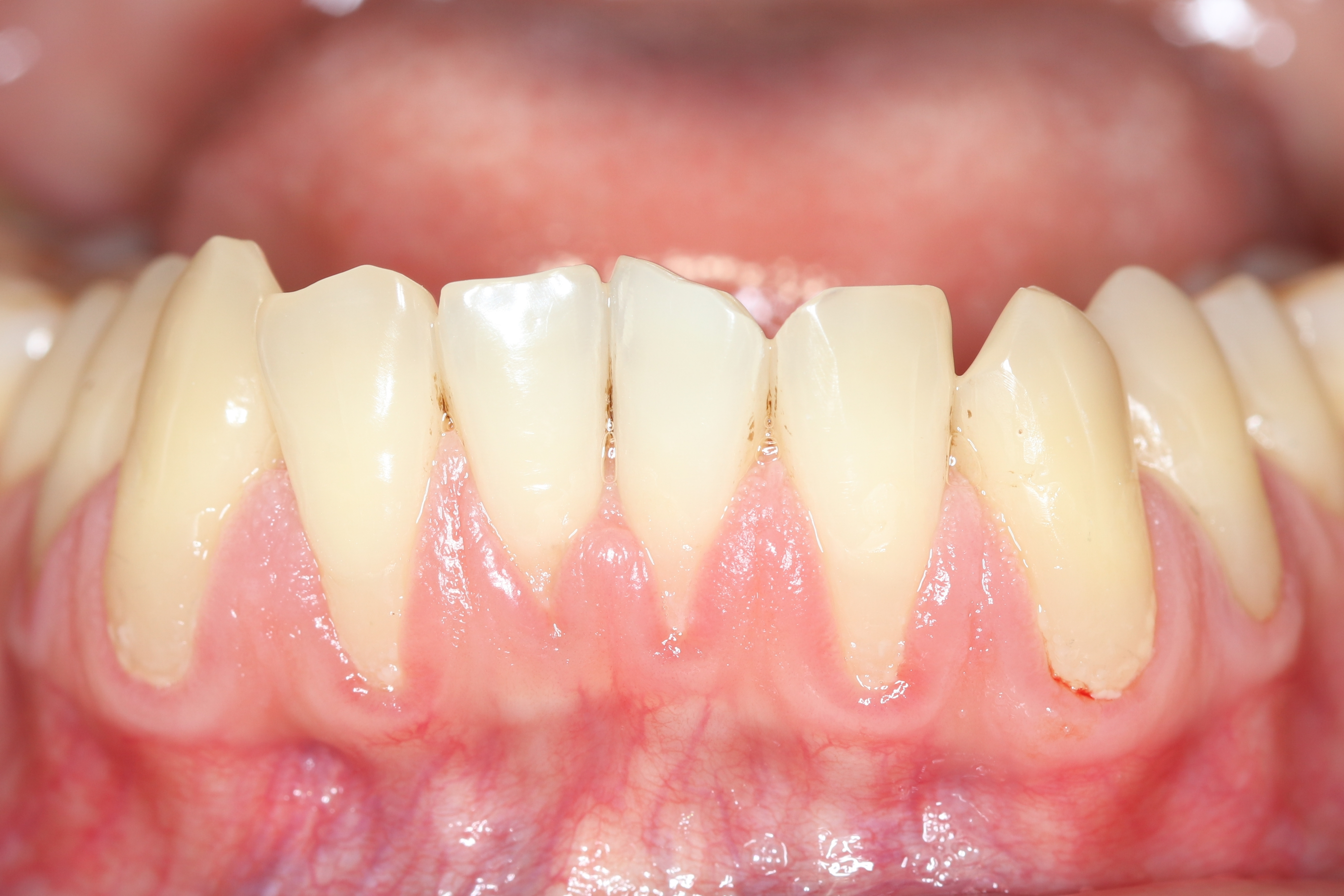 Periodontal assessment at DentAkademi London