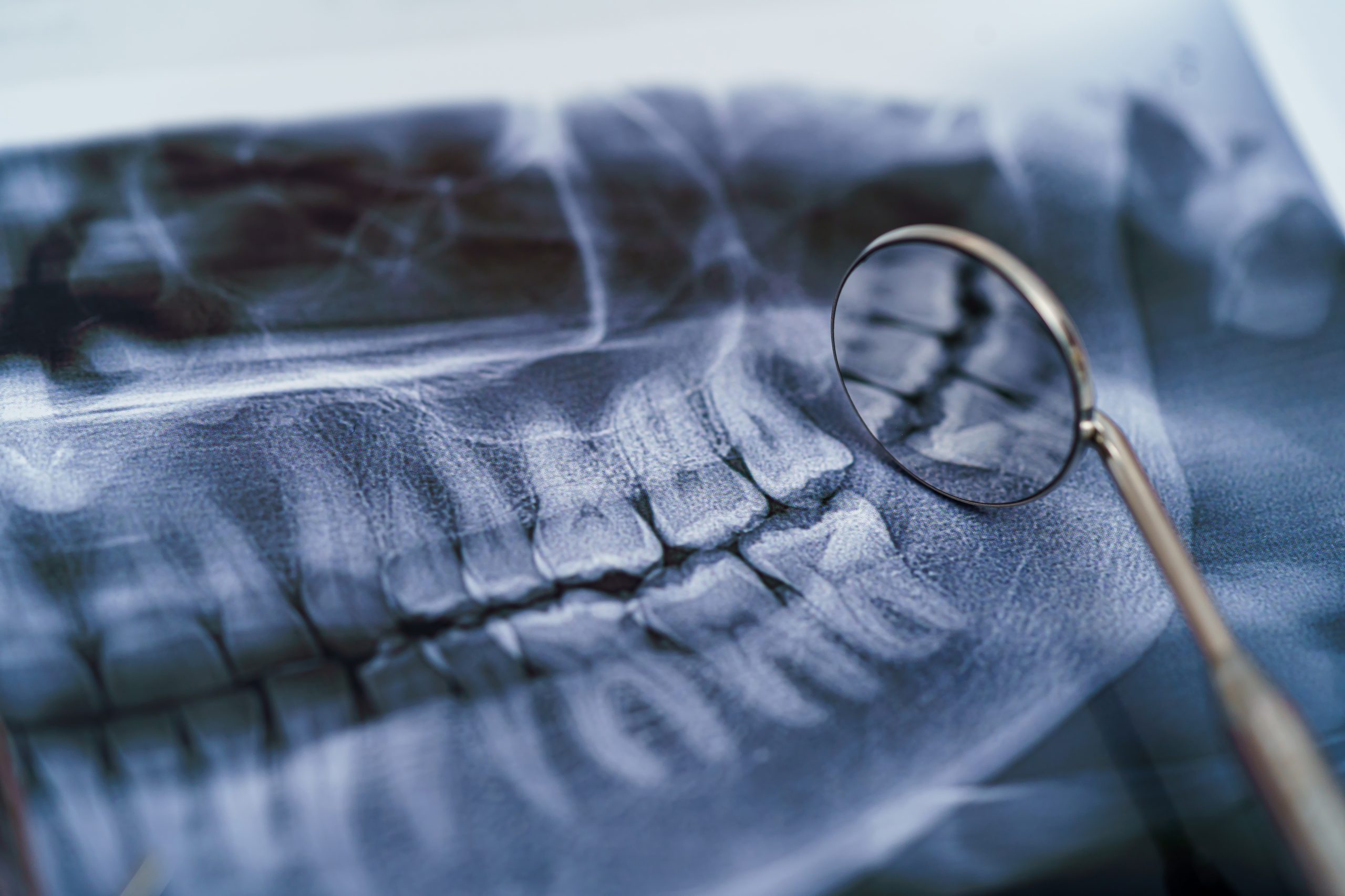Composite Bonding for Uneven Teeth London
