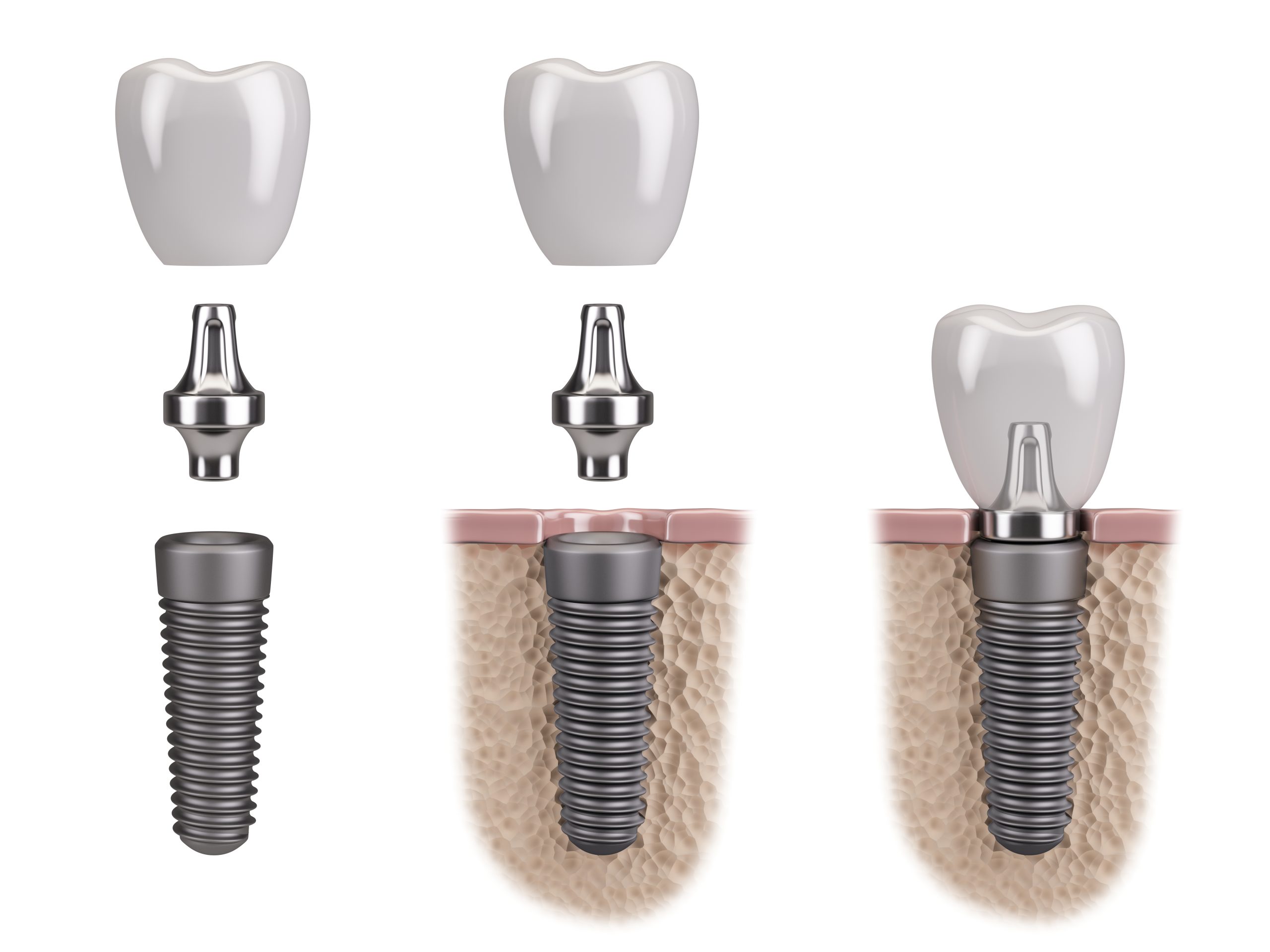 Dental Implants London Prices