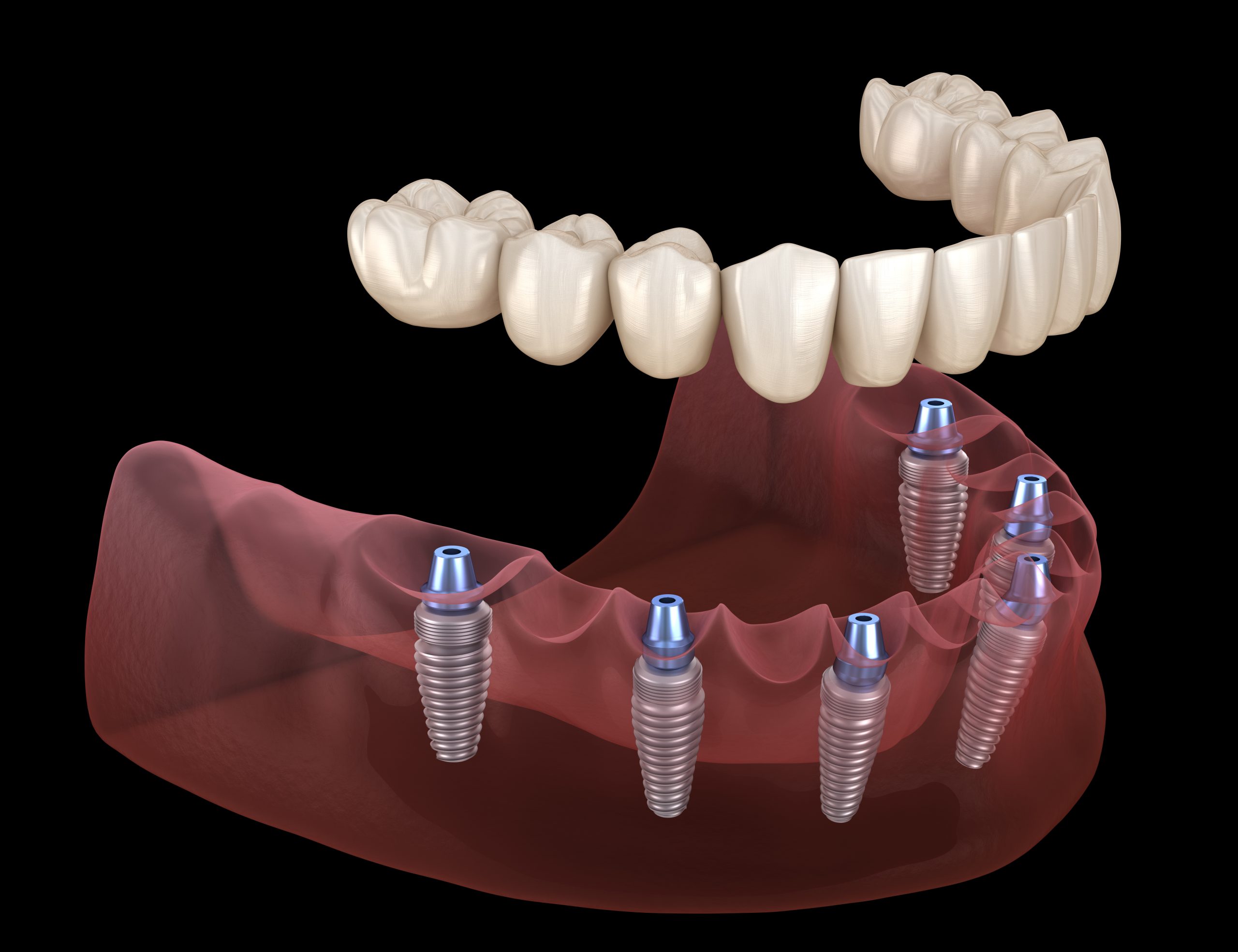 Full Mouth Dental Implant Cost