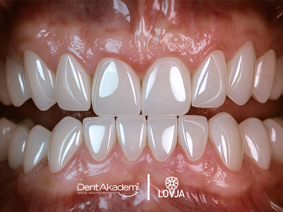 Lovja Ceramirr smile result — DentAkademi London