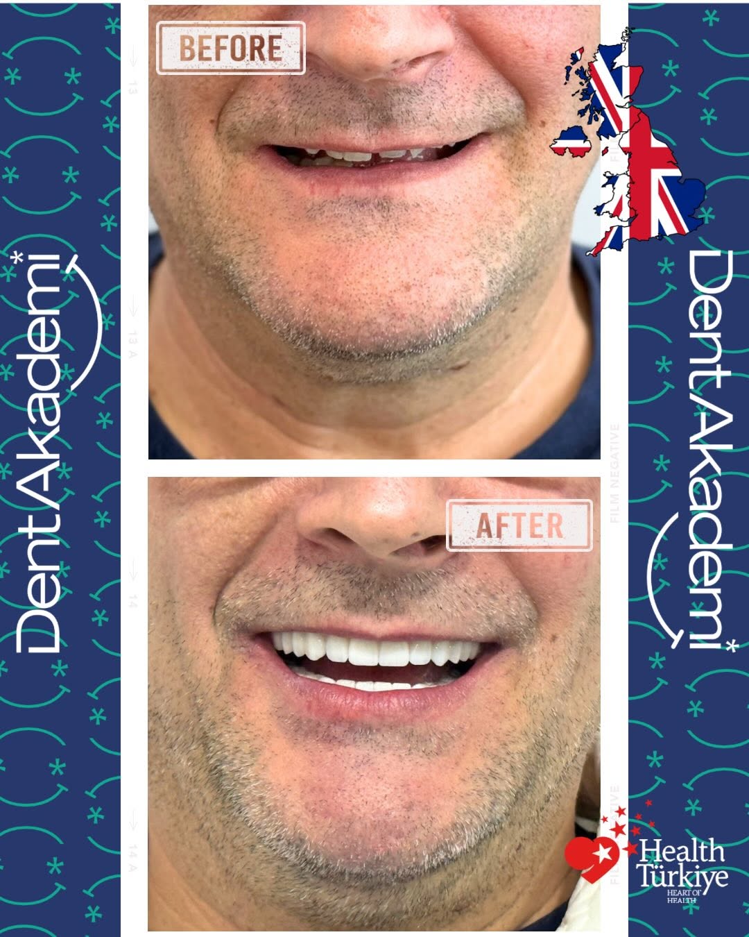 Dental implant treatment result