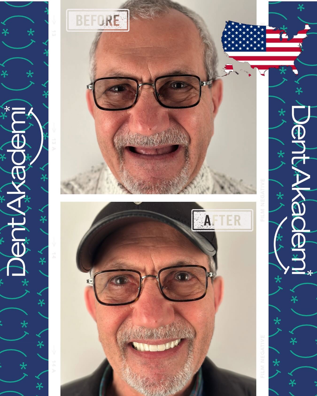 All-on-4 dental implant treatment result