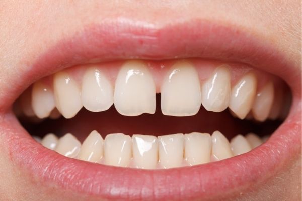 Composite Bonding for Gaps Between Teeth London