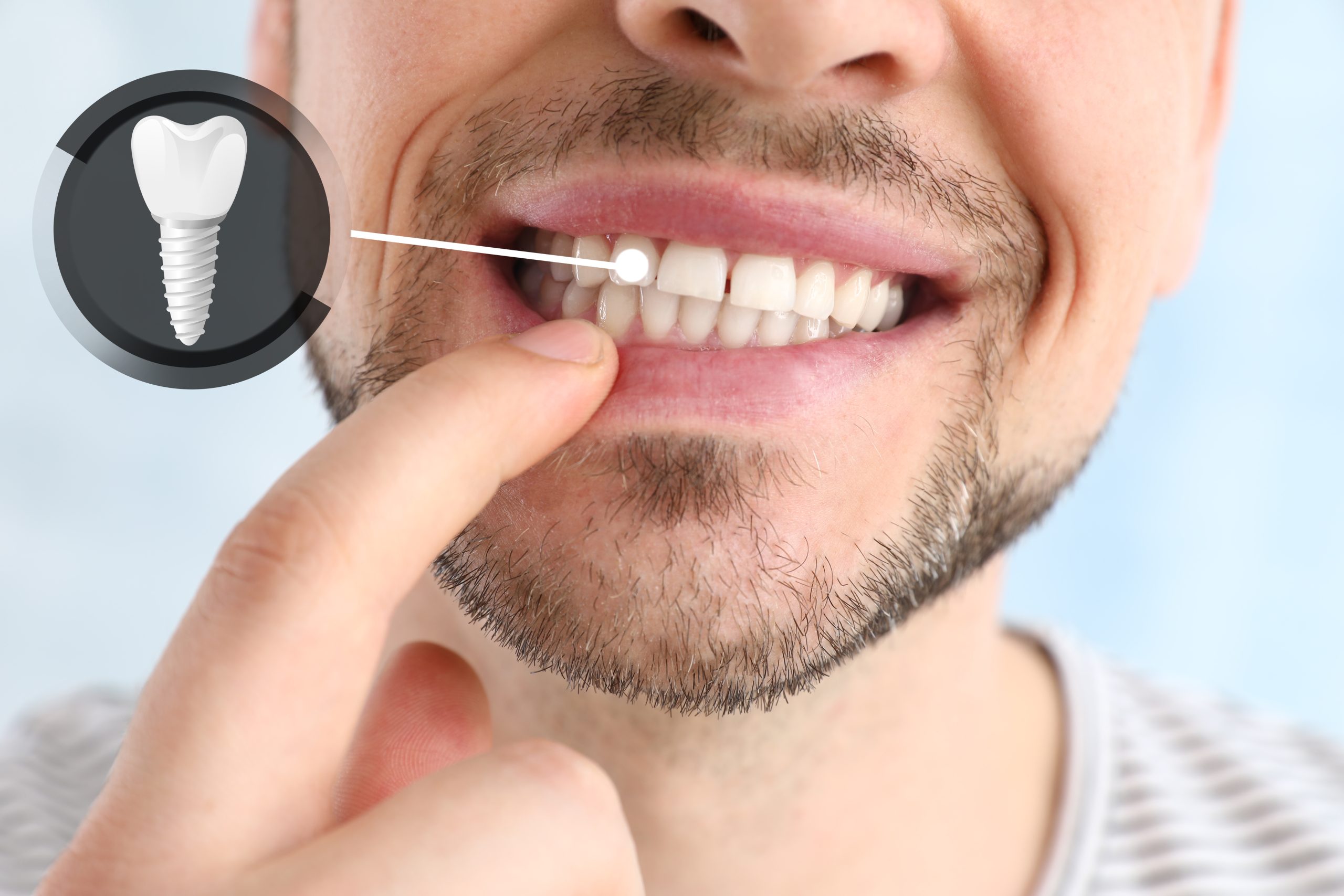 Dental Implant Aftercare