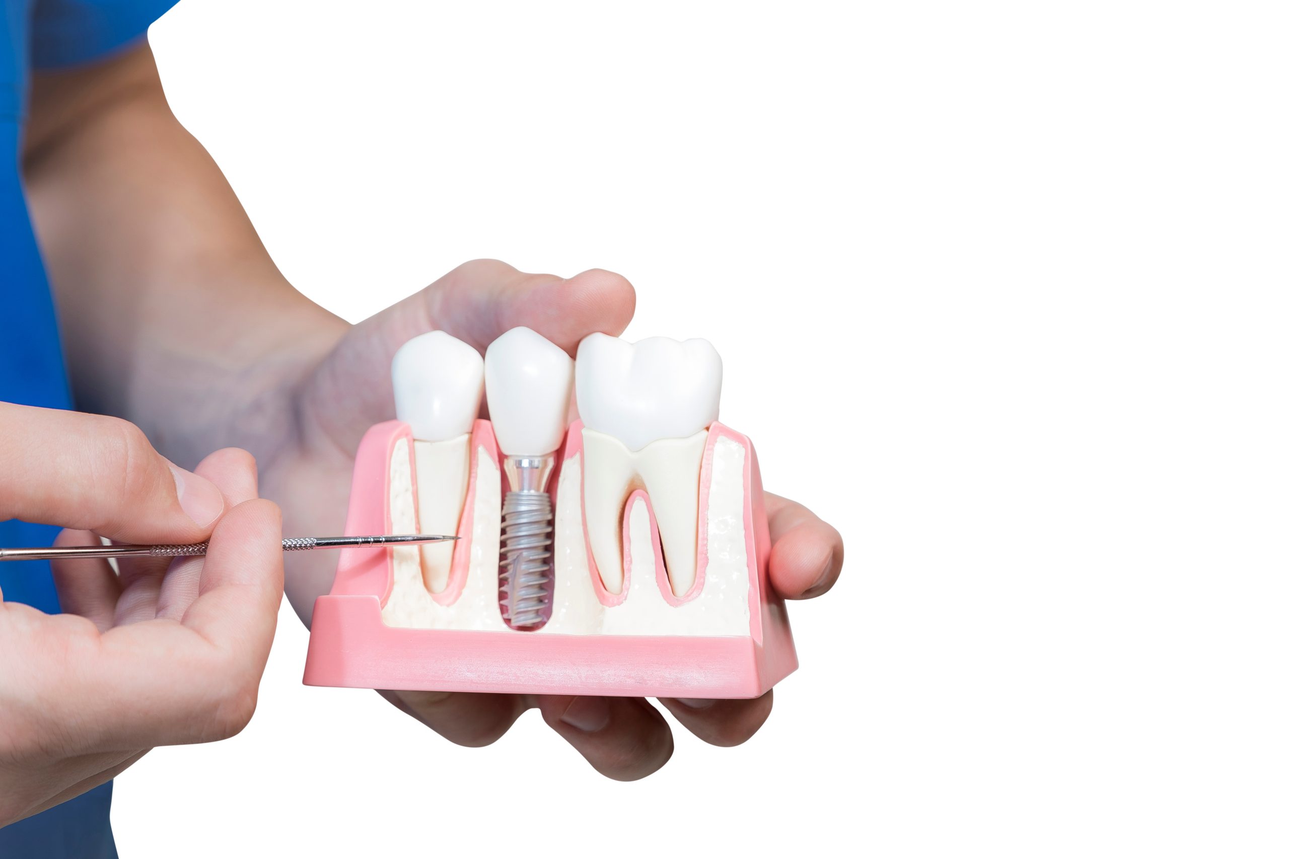 How Long Do Dental Implants Last