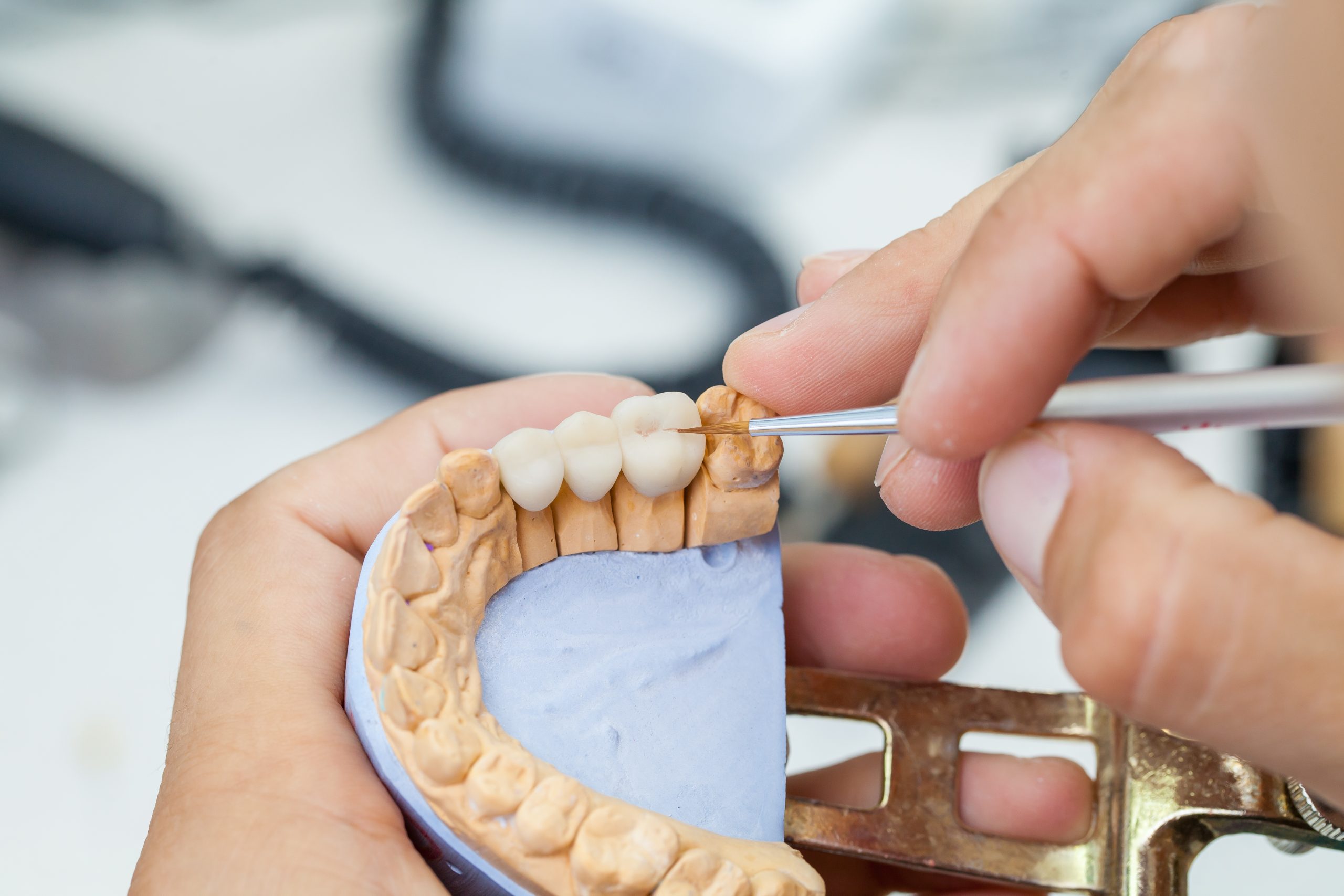 Smile Makeover for Missing Teeth London