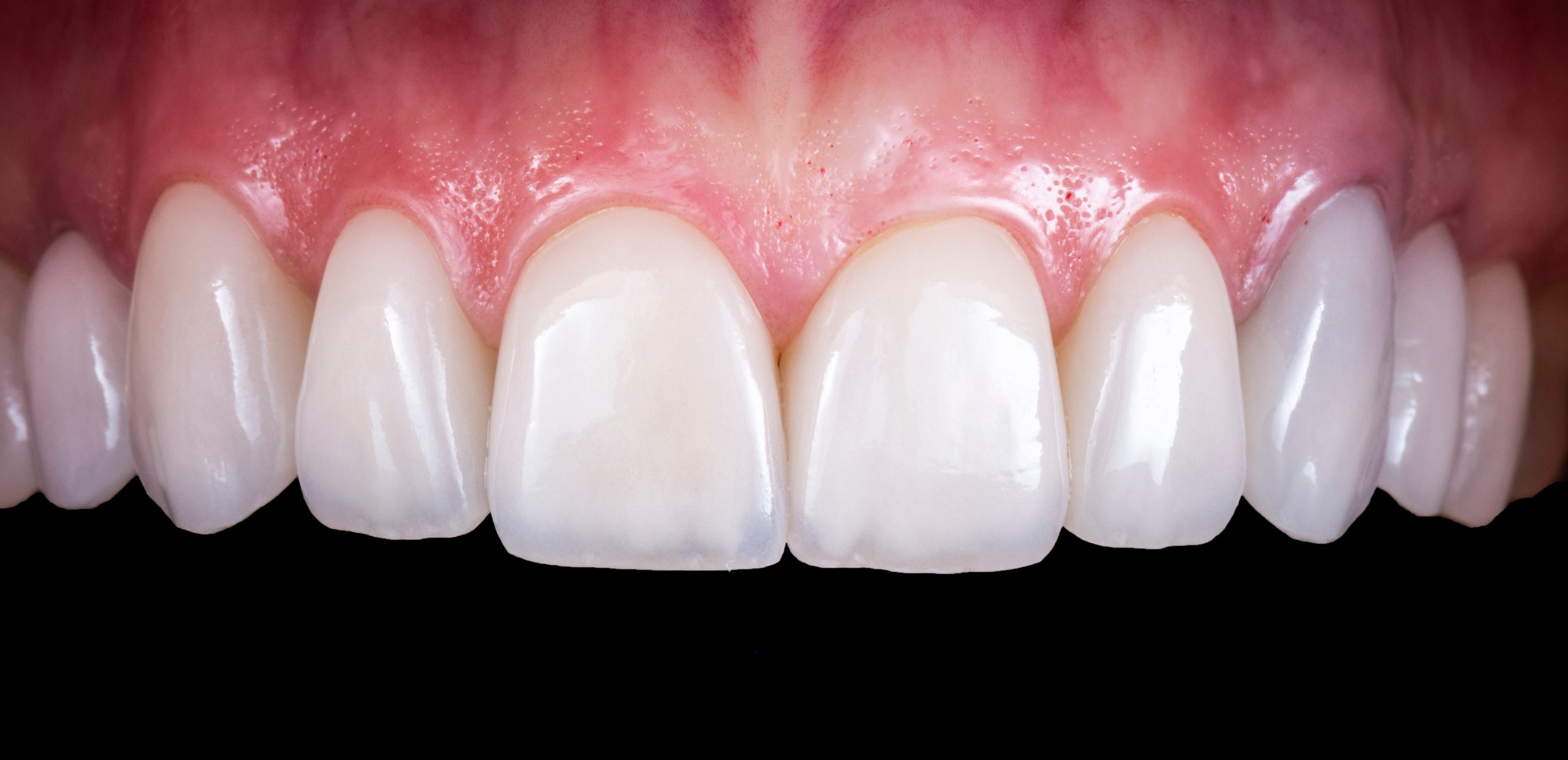 How Long Does a Smile Makeover Take London