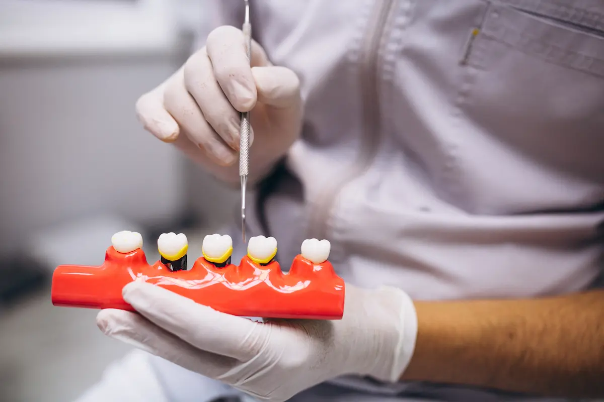 Dental Bridge London